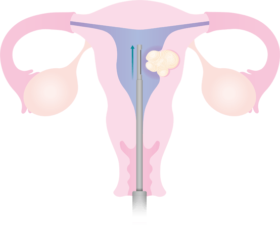 MyoSure stap 4